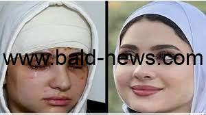 كيفية إصابة البلوجر سارة محمد بالعمى