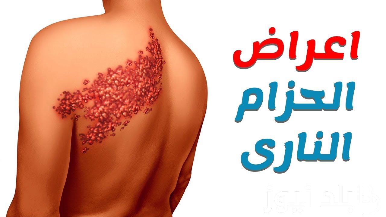 5 أكلات ممنوعة لمريض الحزام الناري بعد توفير التطعيم في مصر