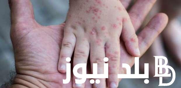 ما هو الفرق بين جدري الماء وجدري القرود 2024 وأعراضه.. “الصحة تكشف”