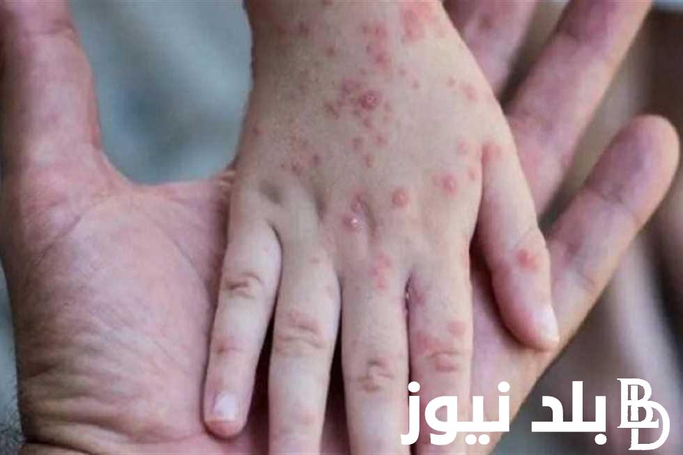 انتشار مرض جدري القرود خارج أفريقيا ومنظمة الصحة العالمية تحذر من خطورته