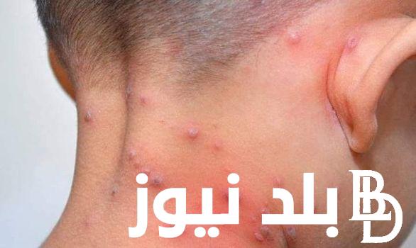 هل يؤدي الي الوفاه ؟.. اعراض جدري القرود المميت وطرق الوقاية منه طبقا لارشادات وزارة الصحة