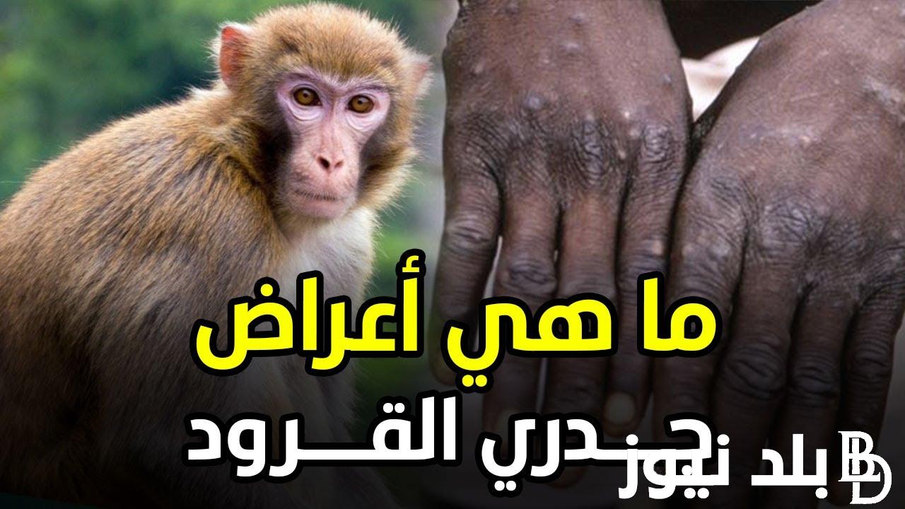 “احمي نفسك”.. تعرف علي أعراض فيروس جدري القرود وأسباب الإصابة به وطرق الوقاية منه
