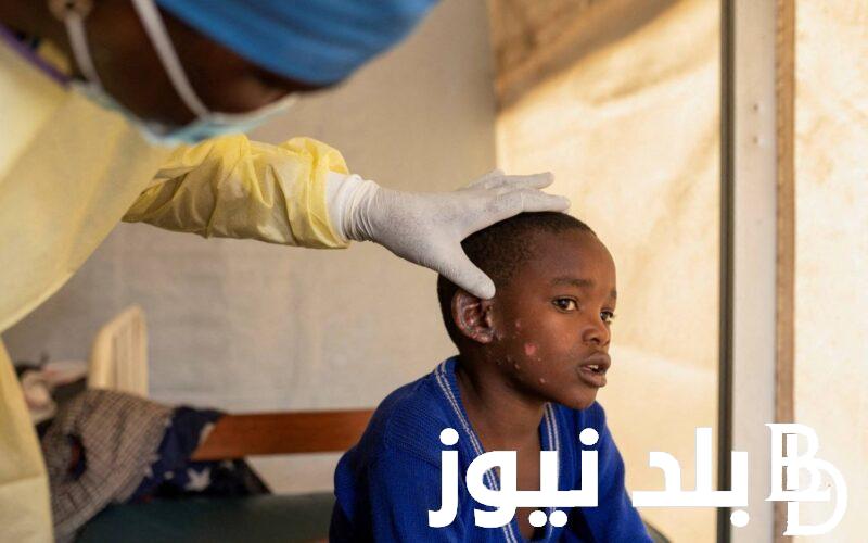 تعرف أعراض جدري القرود المنتشر خارج إفريقيا .. أبرزها تضخم الغدد الليمفاوية