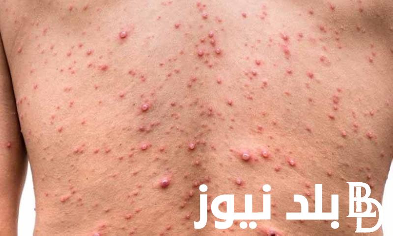 منظمة الصحة العالمية تُحذر من انتشار مرض جدرى القرود 2024 في عدد من الدول وطرق الوقاية من هذا المرض