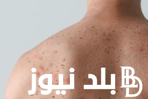 “مرض فيروسي مصدره حيواني” مرض جدري القرود.. اعرف أعراضه والفئة الأكثر عرضة لمضاعفات الإصابة بجدري القرود